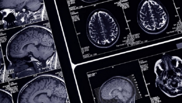 NIKO NE MOŽE DA JE DIJAGNOSTIKUJE! misteriozna bolest mozga zbunjuje naučnike: Počinje polako, a za 18 meseci dolazi do zastrašujućih promena