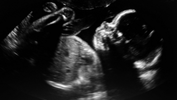 IZVRŠILA ABORTUS U KUĆNIM USLOVIMA Zahvaljujući specifičnoj trudnoći desilo se nešto neverovatno!