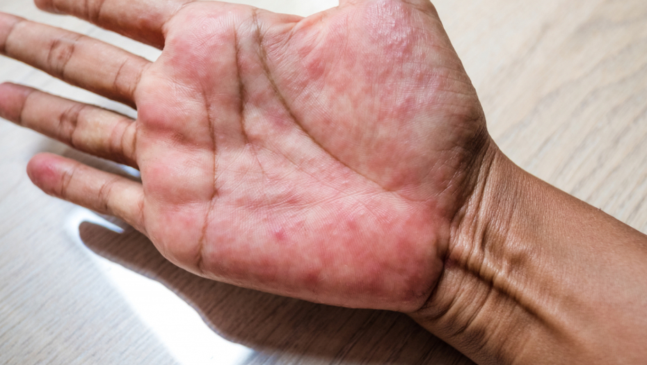 OVA BOLEST SE ŠIRI KAO EPIDEMIJA Gluten uništava štitnu žlezdu, a ovo su znaci da vam škodi