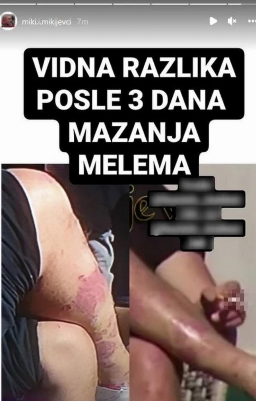 ZARASTAJU MU ŽIVE RANE! Mikijevo telo celo u ožiljcima, kamere zabeležile kako sada izgleda zadrugar zbog bolesti!