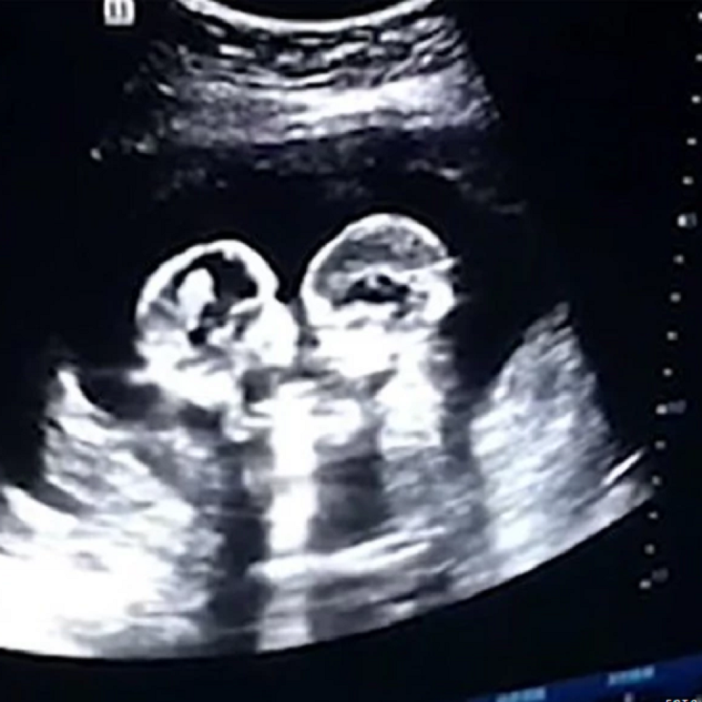 Многоплодная беременность узи. Однояйцевые Близнецы на УЗИ. Снимок УЗИ двойни.