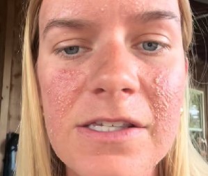 LETOVANJE SE PRETVORILO U HOROR Ujeo je nešto dok je spavala, pa joj se lice IZOBLIČILO – Lekari u šoku, mislili da umišlja! (VIDEO)