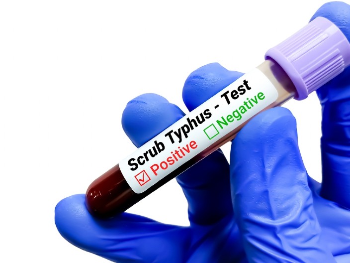 OTKRIVEN TIFUS U FOČI! Uzbuna, zaražena studentkinja Medicinskog fakulteta