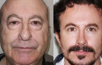 SEDAM OPERACIJA U TURSKOJ PRETVORILE GA U POTPUNO NOVU OSOBU! Da li je ovo isti čovek?