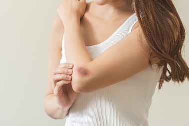 IZLAZE VAM MODRICE BEZ RAZLOGA? To znači da vam telo vrišti za jednim važnim vitaminom