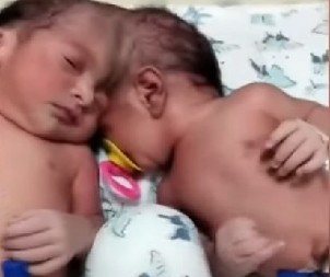 BEBE PREŽIVELE OPERACIJU OD 14 SATI, NJIHOVA PRIČA TERA SUZE NA OČI Evo kako danas žive Mina i Mirka, sijamske bliznakinje koje su razdvojili turski lekari! (VIDEO)