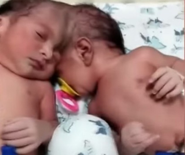 BEBE PREŽIVELE OPERACIJU OD 14 SATI, NJIHOVA PRIČA TERA SUZE NA OČI Evo kako danas žive Mina i Mirka, sijamske bliznakinje koje su razdvojili turski lekari! (VIDEO)